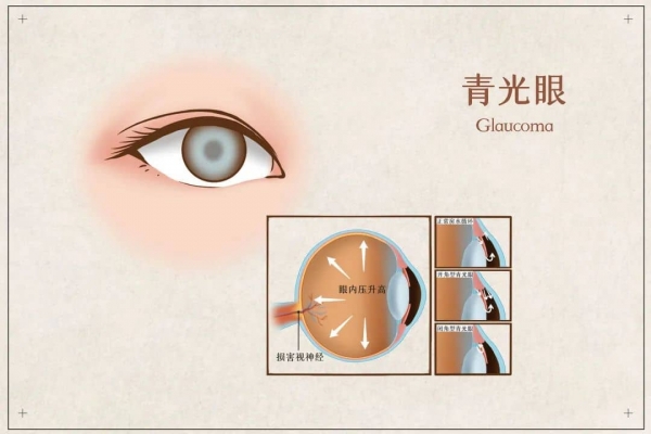 摄图网_401804072_banner_青光眼医疗插画(企业商用).jpg 1-tuya.jpg