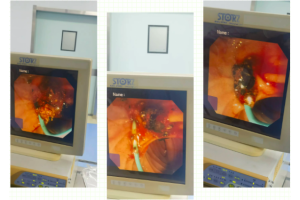 精湛技艺除病痛，携手合作创高效——我院消化科内镜室在外院专家指导下成功完成一例高难度ERCP胆总管取石术