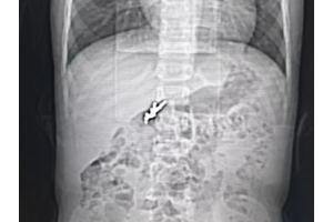 5厘米玩具手枪吞入腹！6岁男孩紧急手术，这些“夺命小物”一定要收好。